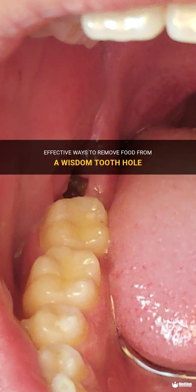 Safe and Effective Ways to Remove Food from Wisdom Tooth Holes